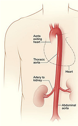 Aortic Aneurysm Treatment Egypt