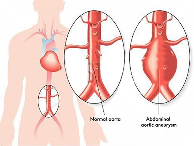 Aortic Aneurysm Treatment Egypt