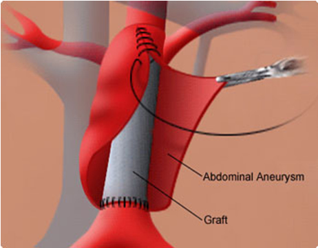 Aortic Aneurysm Treatment Egypt