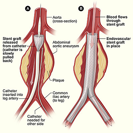 Aortic Aneurysm Treatment Egypt