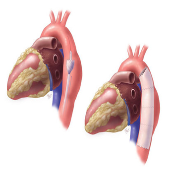 Aortic Aneurysm Treatment Egypt
