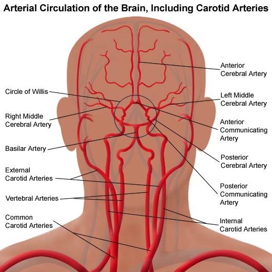carotid artery blockage Egypt