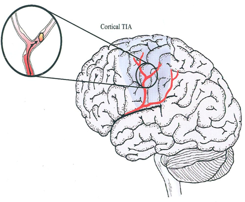 carotid artery blockage Egypt