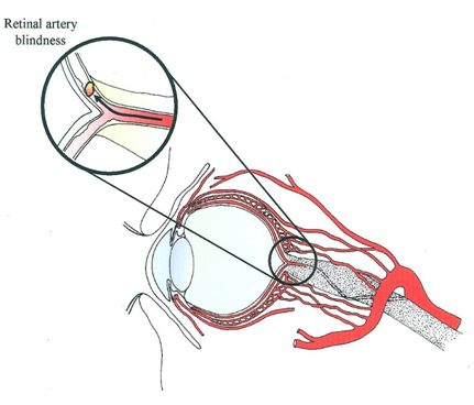 carotid artery blockage Egypt