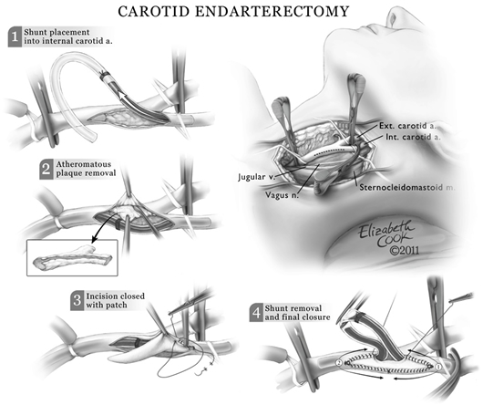 carotid artery blockage Egypt