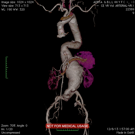 Stents Aortic aneurysms in Egypt